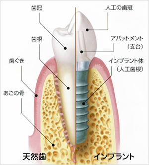 インプラントの説明図