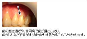 知覚過敏の症例